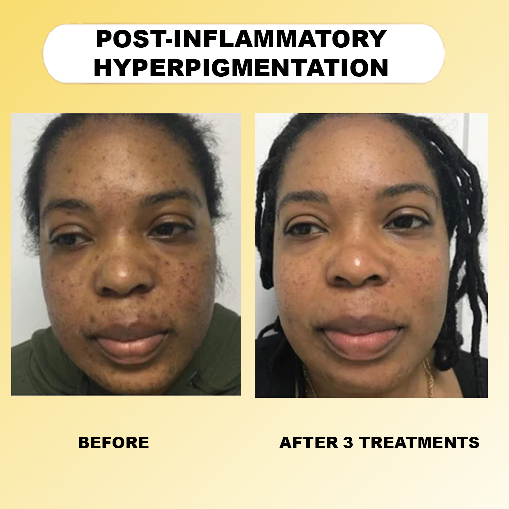 Lorrier Micro Infusion System™