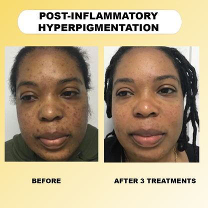 Lorrier Micro Infusion System™