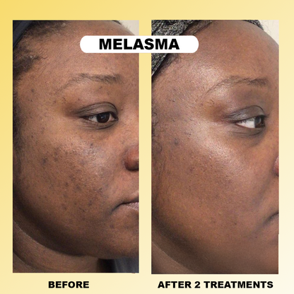 Lorrier Micro Infusion System™